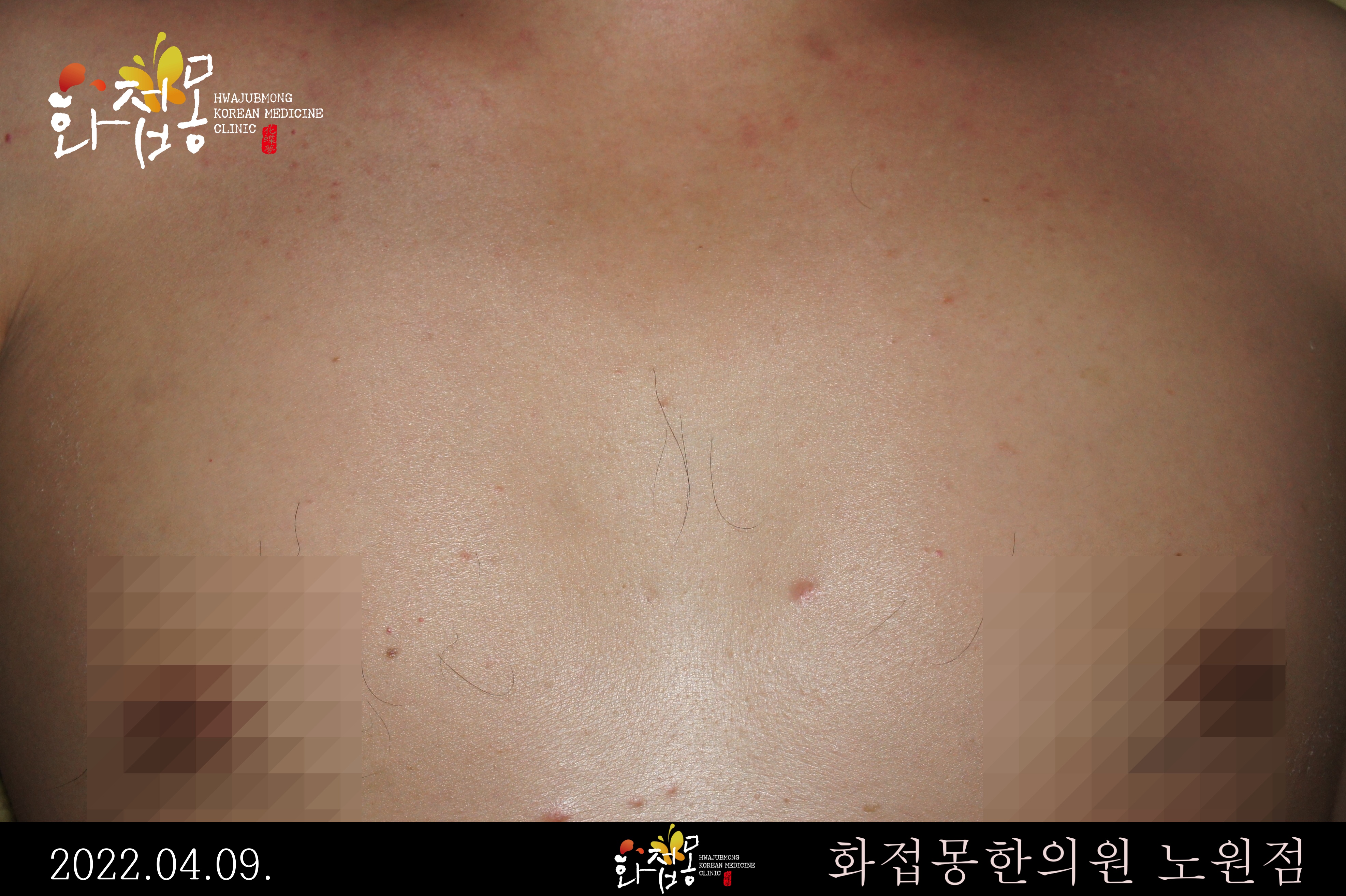 전후사진