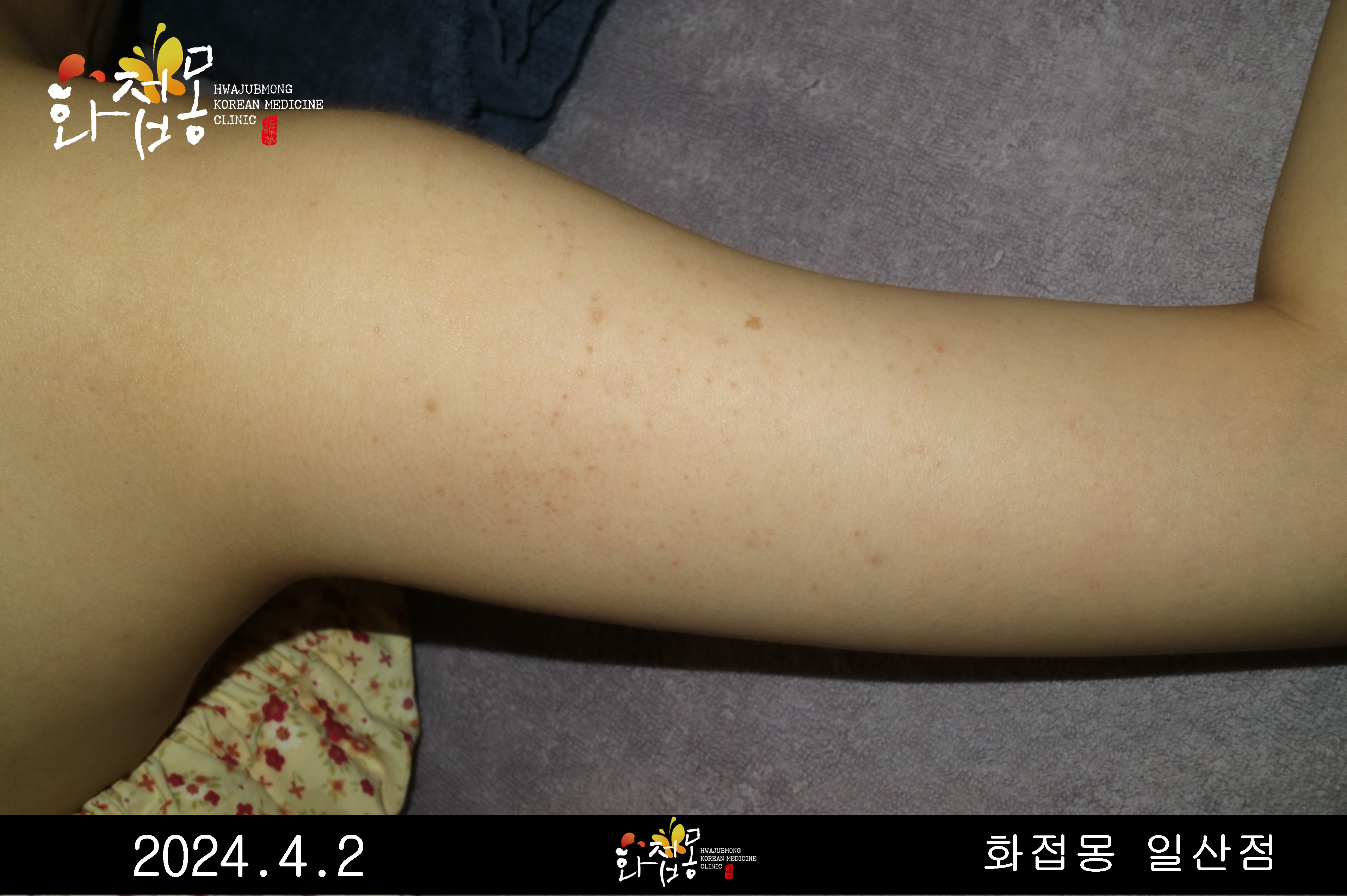 전후사진