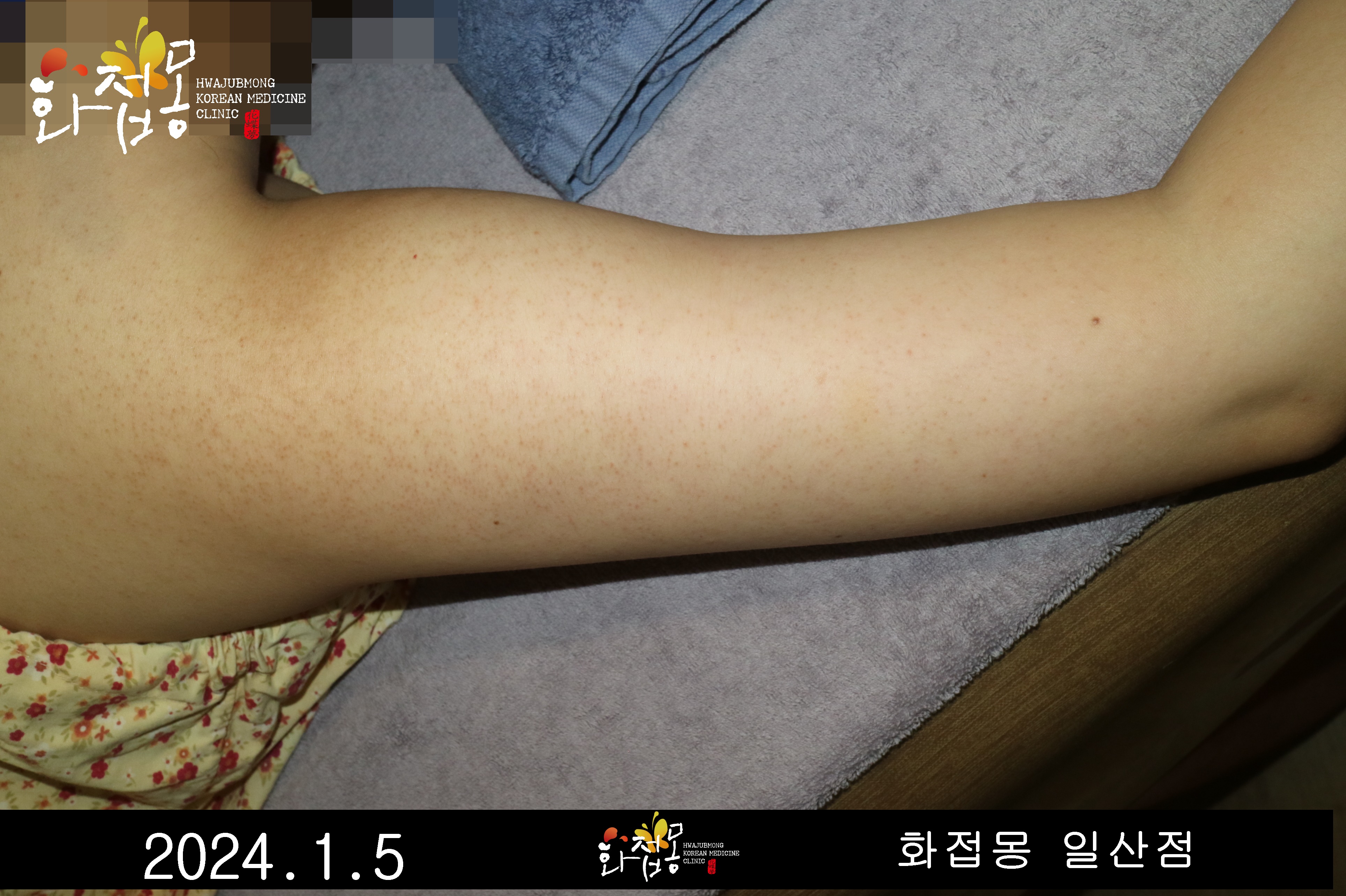 전후사진