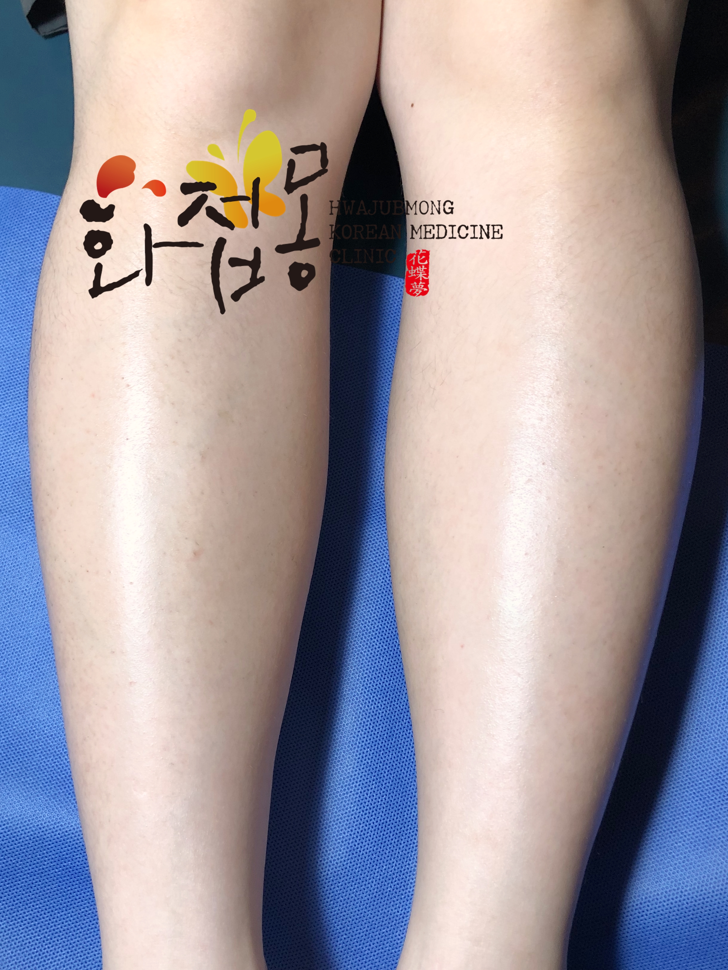 전후사진