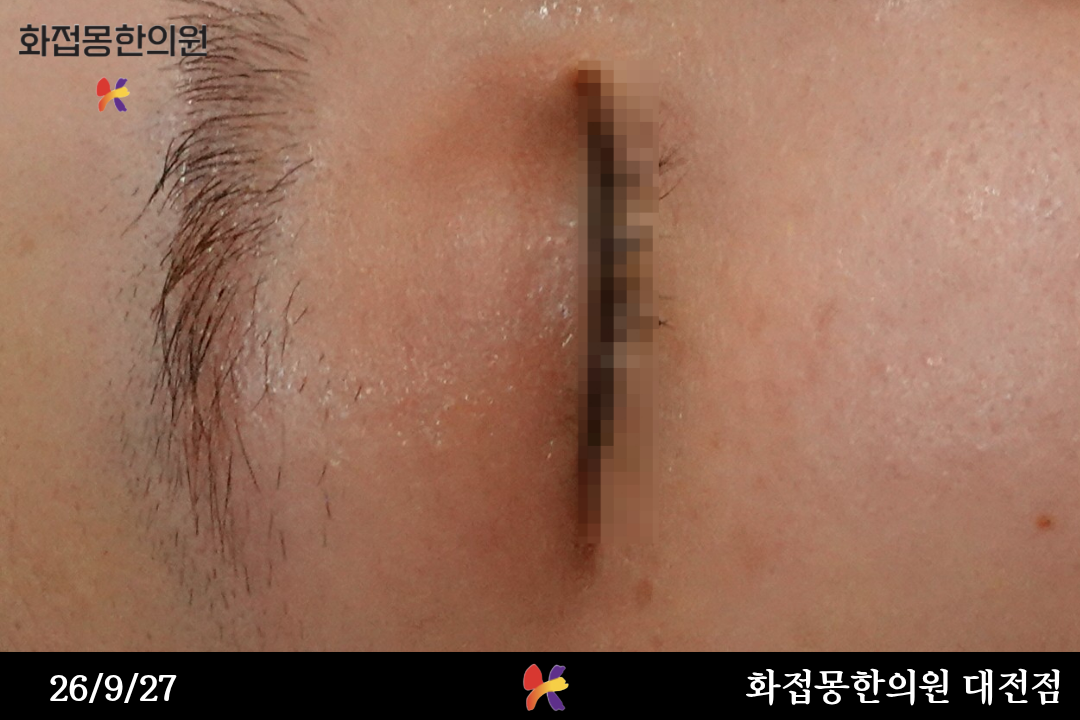 전후사진