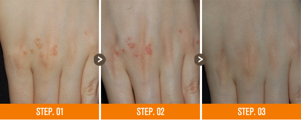 화접몽한의원 편평사마귀 전후사진