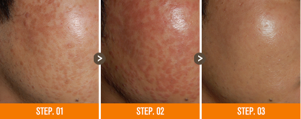 화접몽한의원 편평사마귀 전후사진