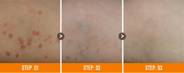 화접몽한의원 편평사마귀 전후사진