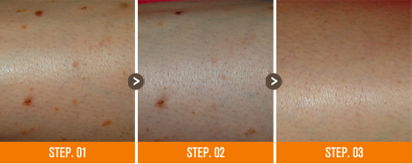 화접몽한의원 편평사마귀 전후사진