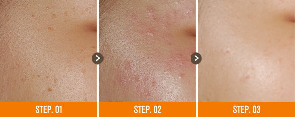 화접몽한의원 편평사마귀 전후사진