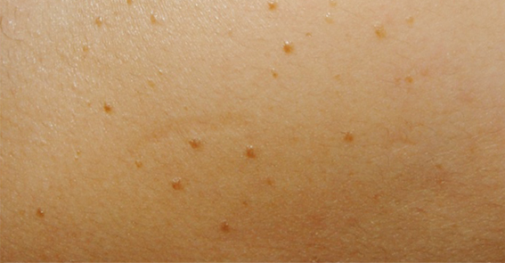 비 활동성 사마귀