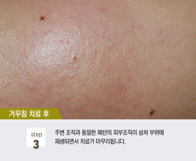 지루각화증(검버섯)